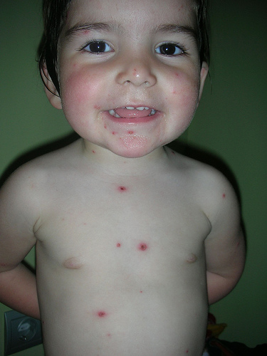 Nene con varicela